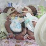 KEMBAR. Bayi siam dempet perut menjalni perawatan intensif di ruang NICU RSUD Sidoarjo. foto: catur andy/ BANGSAONLINE