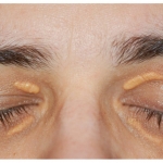 Penyebab Munculnya Xanthelasma, Bercak Warna Kuning di Sekitar Mata. Foto: Ist