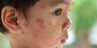 Virus Varicella-Zoster, Penyebab Cacar Air? Gejala, Risiko dan Pengobatannya