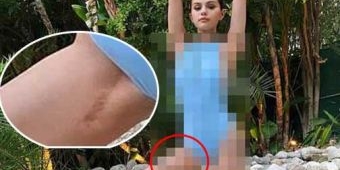 ​Selena Gomez Pamer Bekas Sayatan Operasi Transplantasi Ginjal