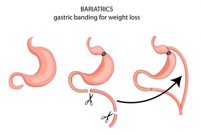 Operasi Potong Lambung dapat Menurunkan Berat Badan