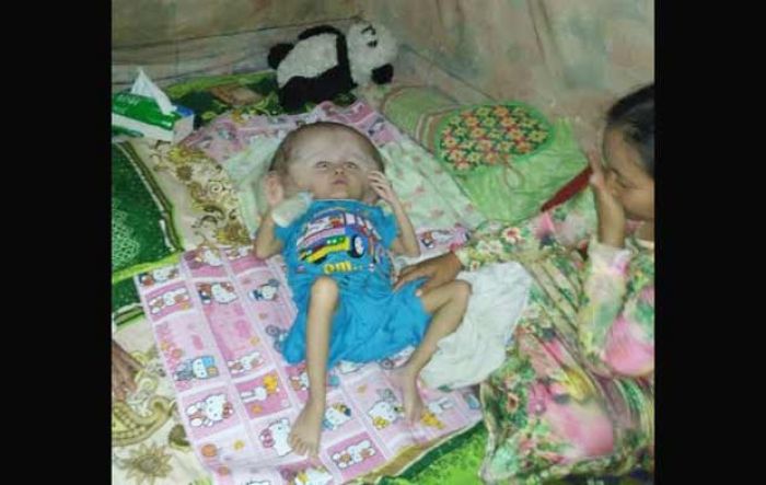 Dinkes Lamongan Periksakan Balita Penderita Hydrocephalus ke RSUD Dr Soegiri