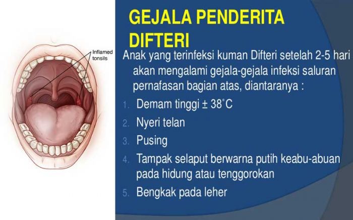 Bocah 11 Tahun di Tuban Meninggal Akibat Penyakit Difteri