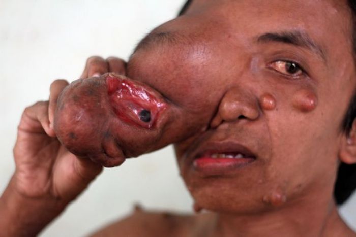 Naudzubillah, Tumor Jadikan Satu Mata Herdi Firmansyah Menggantung