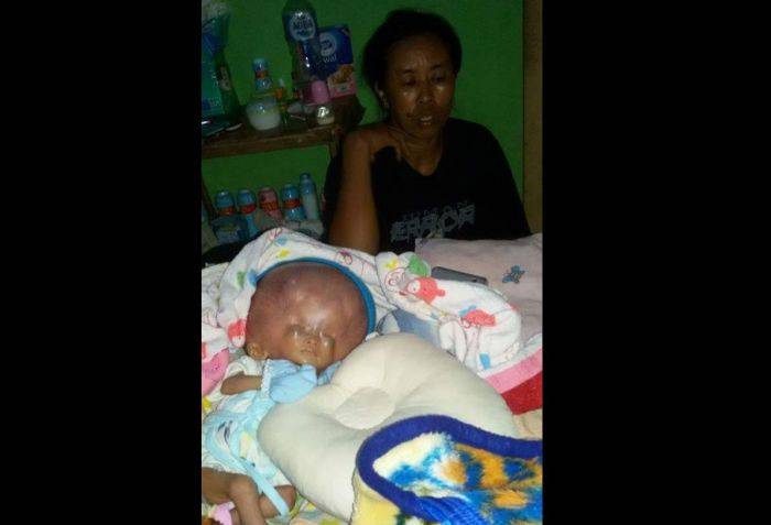 Bayi Pengidap Hydrocephalus di Trenggalek Akhirnya Dilarikan ke RSUD Dr. Soetomo