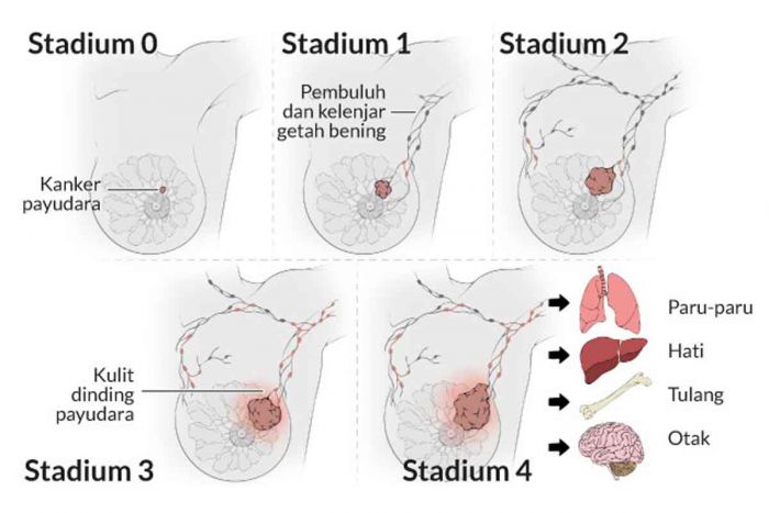 Ini Cara Cegah Kanker Payudara, Salah Satunya dengan Menyusui